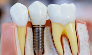 A Popular Option for Tooth Replace
