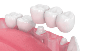 porcelain dental health