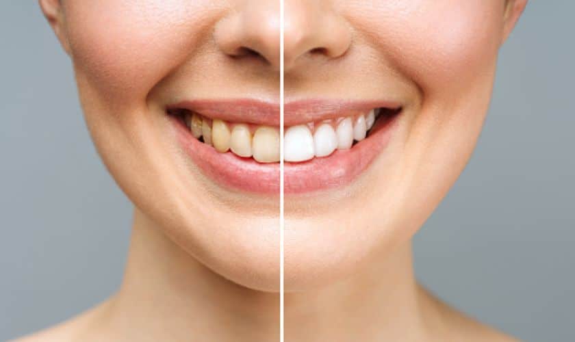 Teeth Whitening at Millar Dental and Orthodontics